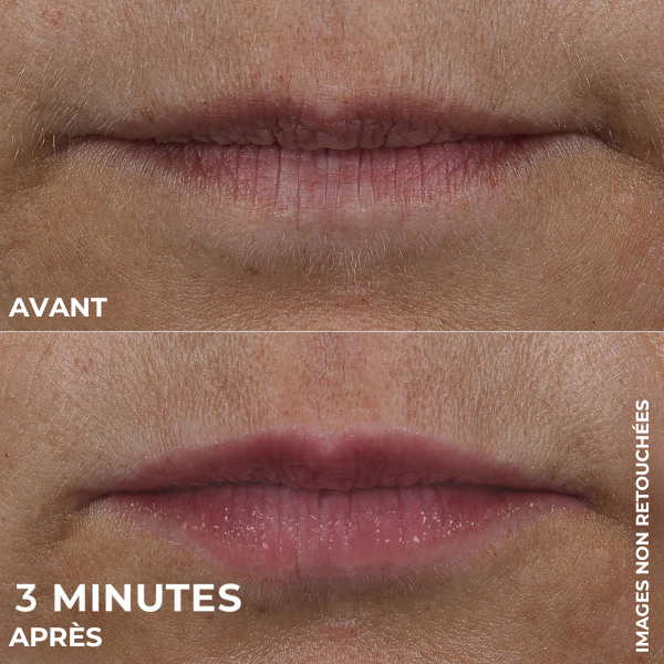 Lip Volumizer Elixa™